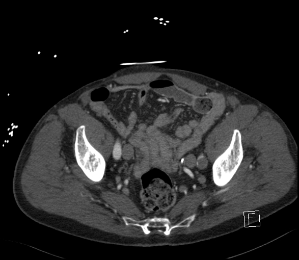 Aortic dissection (CTPA) (Radiopaedia 75506-86750 E 128).jpg
