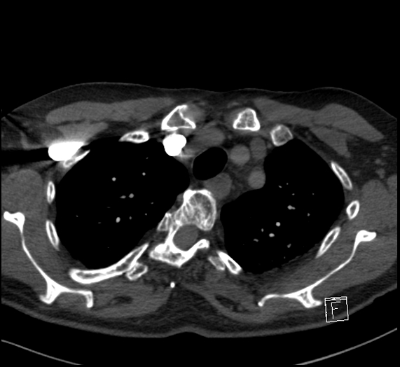 File:Aortic dissection (CTPA) (Radiopaedia 75506-86751 Axial C+ CTPA 28).jpg