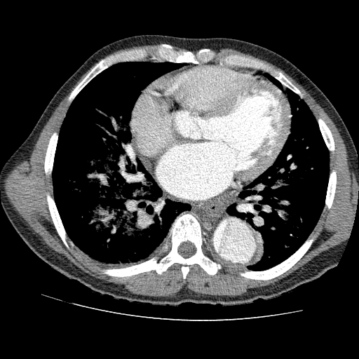 File:Aortic dissection - Stanford A -DeBakey I (Radiopaedia 28339-28587 B 58).jpg