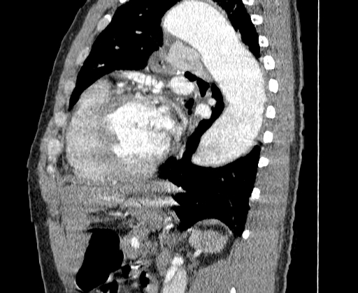 Aortic dissection - Stanford A -DeBakey I (Radiopaedia 28339-28587 C 57).jpg