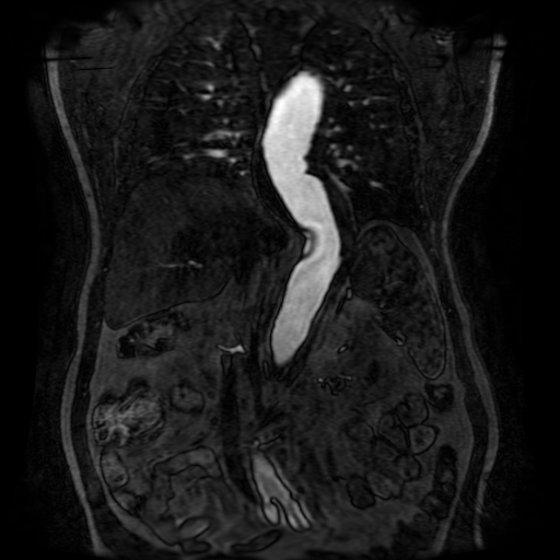 Aortic dissection - Stanford A - DeBakey I (Radiopaedia 23469-23551 D 148).jpg