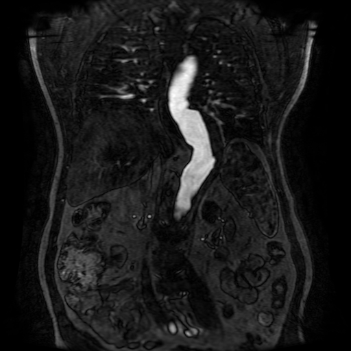 File:Aortic dissection - Stanford A - DeBakey I (Radiopaedia 23469-23551 D 155).jpg