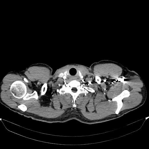 Aortic dissection - Stanford type A (Radiopaedia 83418-98500 A 2).jpg