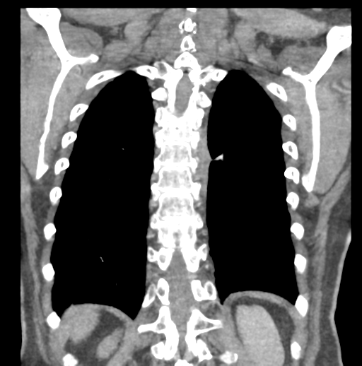 File:Aortic dissection - Stanford type B (Radiopaedia 50171-55512 B 69).png