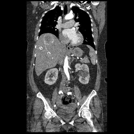 File:Aortic dissection - Stanford type B (Radiopaedia 88281-104910 B 36).jpg