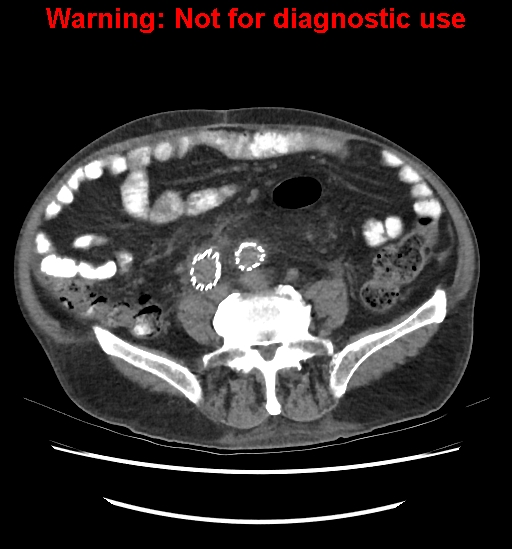 File:Aortic graft infection (Radiopaedia 44979-48907 Axial non-contrast 62).jpg