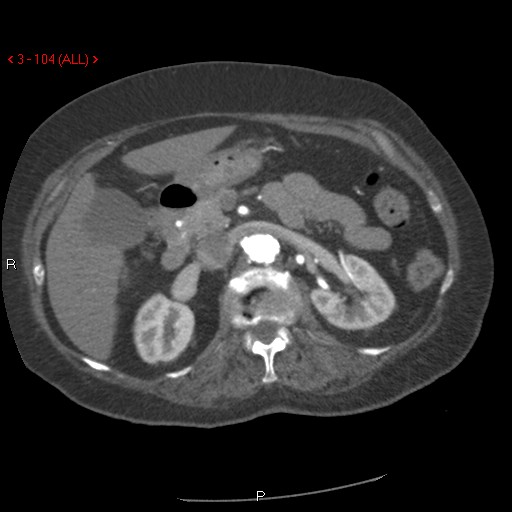 File:Aortic intramural hematoma (Radiopaedia 27746-28001 A 104).jpg