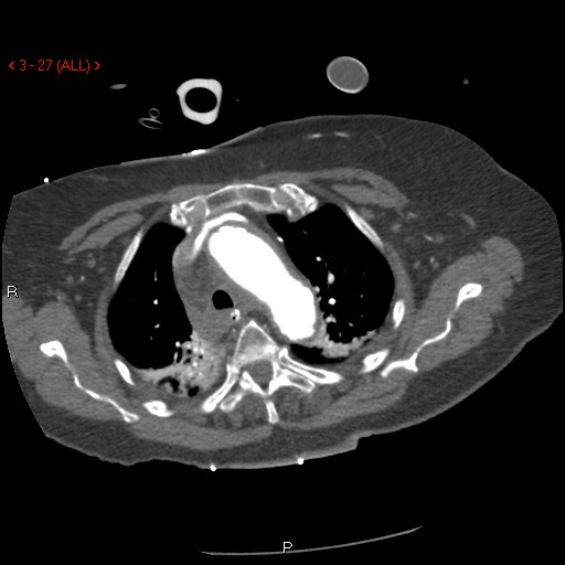 Aortic intramural hematoma (Radiopaedia 27746-28001 A 27).jpg