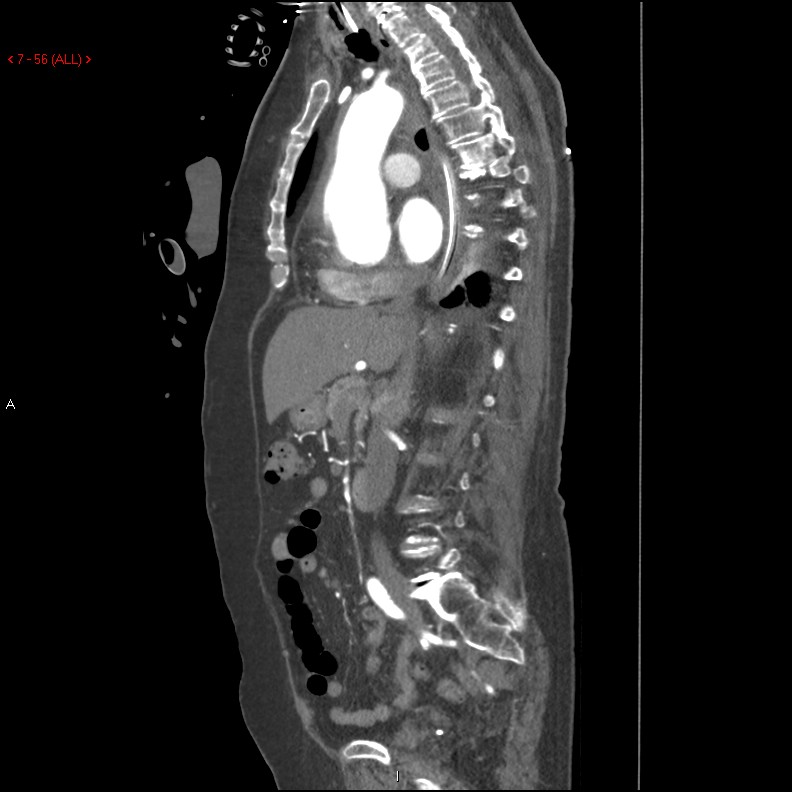 Aortic intramural hematoma (Radiopaedia 27746-28001 C 25).jpg