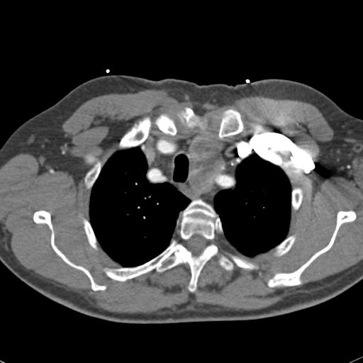 File:Aortic intramural hematoma (Radiopaedia 31139-31838 B 16).jpg
