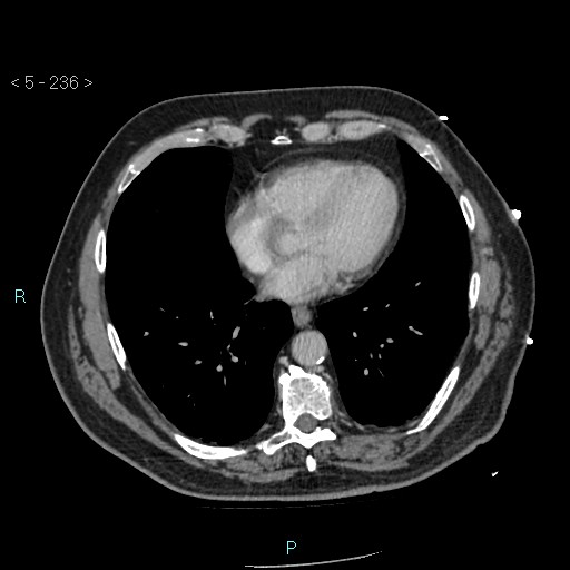 File:Aortic intramural hematoma (Radiopaedia 48463-53380 C 106).jpg