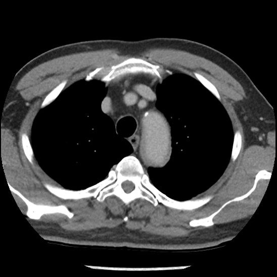 Aortic intramural hematoma (type B) (Radiopaedia 79323-92387 Axial C+ delayed 10).jpg