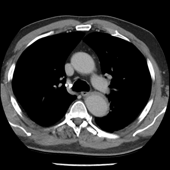 Aortic intramural hematoma (type B) (Radiopaedia 79323-92387 Axial C+ delayed 18).jpg