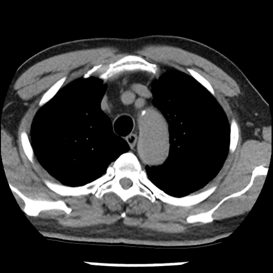 Aortic intramural hematoma (type B) (Radiopaedia 79323-92387 Axial non-contrast 10).jpg