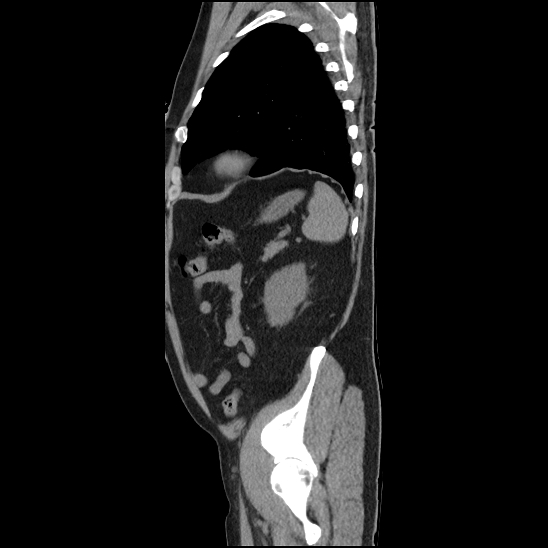 File:Aortic intramural hematoma (type B) (Radiopaedia 79323-92387 G 45).jpg