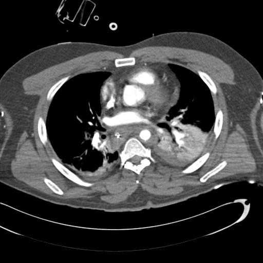 Aortic transection, diaphragmatic rupture and hemoperitoneum in a complex multitrauma patient (Radiopaedia 31701-32622 A 46).jpg