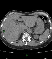 Aortic valve endocarditis (Radiopaedia 87209-103485 Axial non-contrast 94).jpg