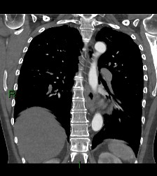 Aortic valve endocarditis (Radiopaedia 87209-103485 D 25).jpg