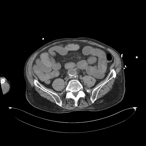 Aortoduodenal fistula (Radiopaedia 75286-86415 Axial non-contrast 46).jpg