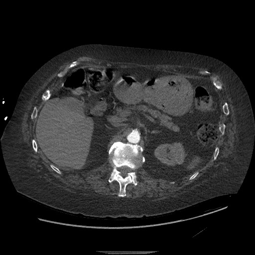 Aortoesophageal fistula with endovascular repair (Radiopaedia 73781-84592 Axial C+ CTPA 200).jpg