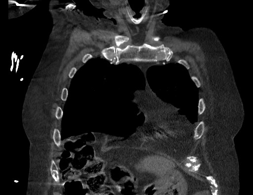 Aortoesophageal fistula with endovascular repair (Radiopaedia 73781-84592 Coronal C+ CTPA 17).jpg