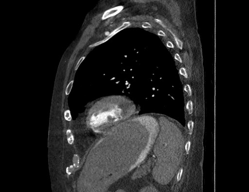 Aortoesophageal fistula with endovascular repair (Radiopaedia 73781-84592 Sagittal C+ CTPA 151).jpg