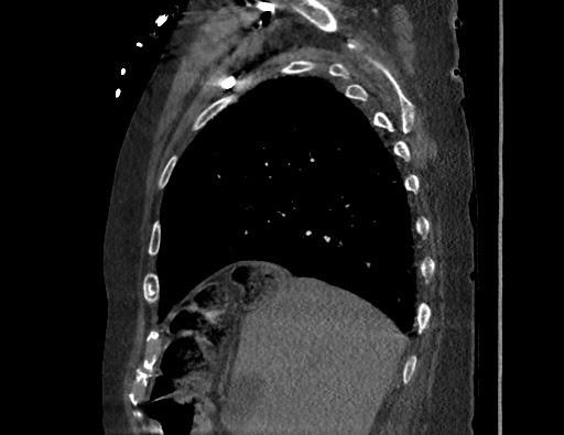 Aortoesophageal fistula with endovascular repair (Radiopaedia 73781-84592 Sagittal C+ CTPA 43).jpg