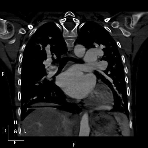 File:Aortopulmonary septal defect (Radiopaedia 41990-45013 Coronal C+ CTPA 39).jpg