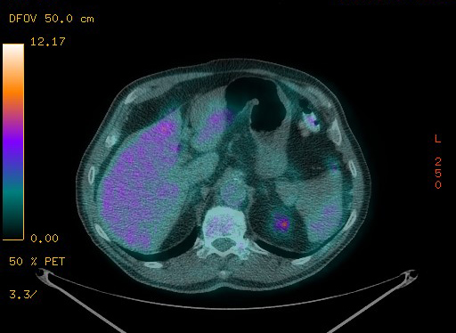 Appendiceal adenocarcinoma complicated by retroperitoneal abscess (Radiopaedia 58007-65041 Axial PET-CT 106).jpg