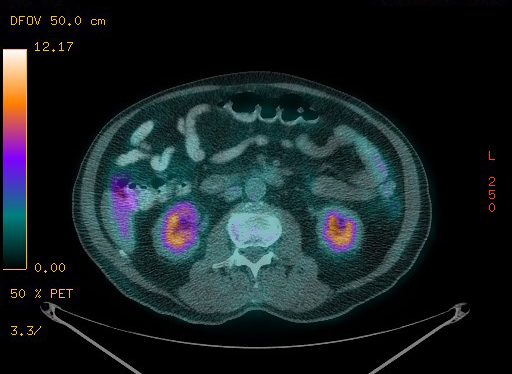 Appendiceal adenocarcinoma complicated by retroperitoneal abscess (Radiopaedia 58007-65041 Axial PET-CT 126).jpg