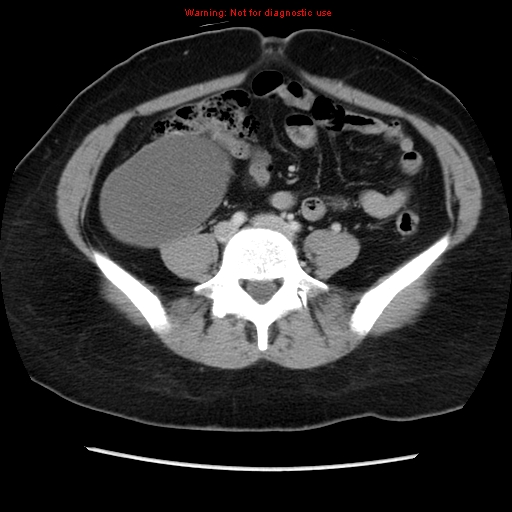 File:Appendiceal mucinous cystadenoma (Radiopaedia 8263-9111 Axial liver window 54).jpg