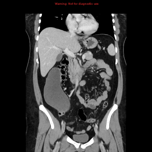 Appendiceal mucinous cystadenoma (Radiopaedia 8263-9111 B 33).jpg