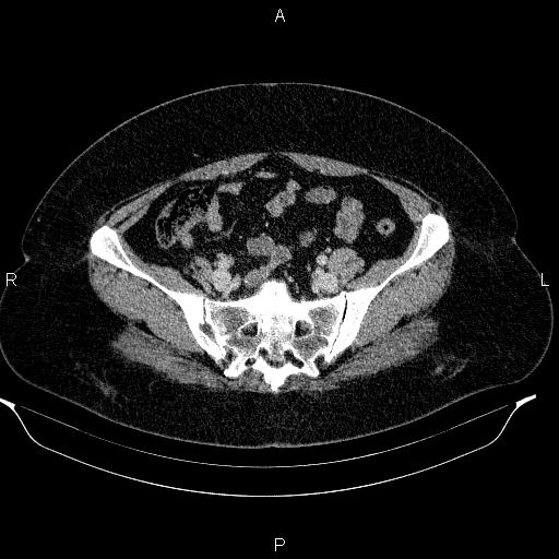 Appendiceal mucocele (Radiopaedia 83280-97688 Axial With contrast 81).jpg