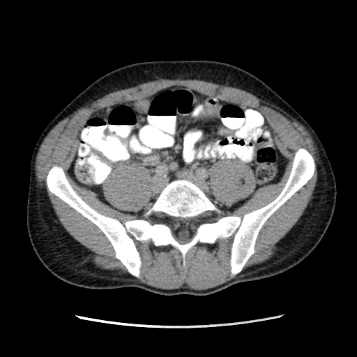 File:Appendicitis complicated by post-operative collection (Radiopaedia 35595-37113 A 51).jpg