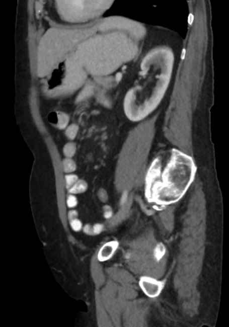 Appendicitis due to chicken fibula (Radiopaedia 74314-85198 C 69).jpg