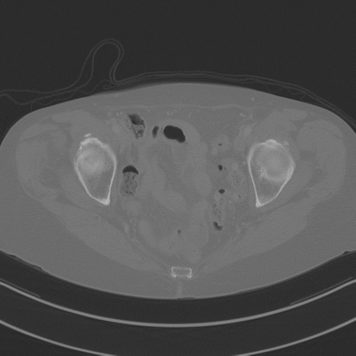 April fools' 2019- calcified peritoneal arachnoidosis (Radiopaedia 67273-76636 Axial bone window 50).png