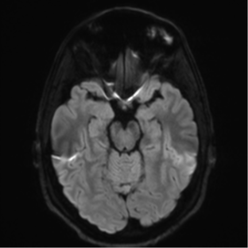 Arachnoid cyst - cerebellopontine angle (Radiopaedia 59689-67083 Axial DWI 50).png