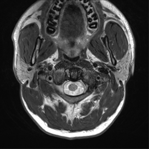 File:Arachnoid cyst - cerebellopontine angle (Radiopaedia 59689-67083 Axial T2 1).png