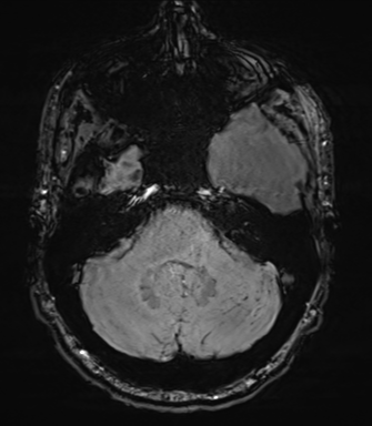 Arachnoid cyst with subdural hematoma (Radiopaedia 85892-101743 Axial SWI 17).png