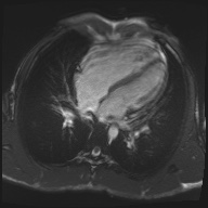 File:Arrhythmogenic right ventricular cardiomyopathy (Radiopaedia 57972-64966 A 22).jpg