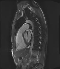 File:Arrhythmogenic right ventricular cardiomyopathy (Radiopaedia 57972-64966 Cine RVOT SSFP 22).jpg