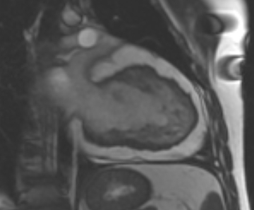 Arrhythmogenic right ventricular cardiomyopathy (Radiopaedia 69431-79307 2ch cine 34).jpg