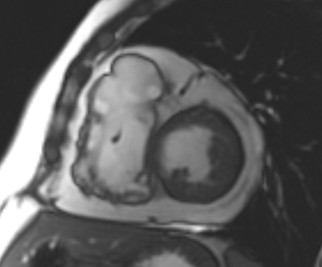 Arrhythmogenic right ventricular cardiomyopathy (Radiopaedia 69431-79307 Short axis cine 128).jpg