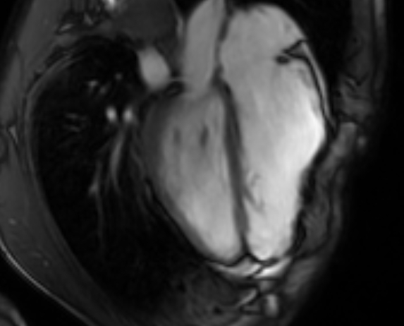 File:Arrhythmogenic right ventricular cardiomyopathy (Radiopaedia 69564-79464 4ch cine 94).jpg