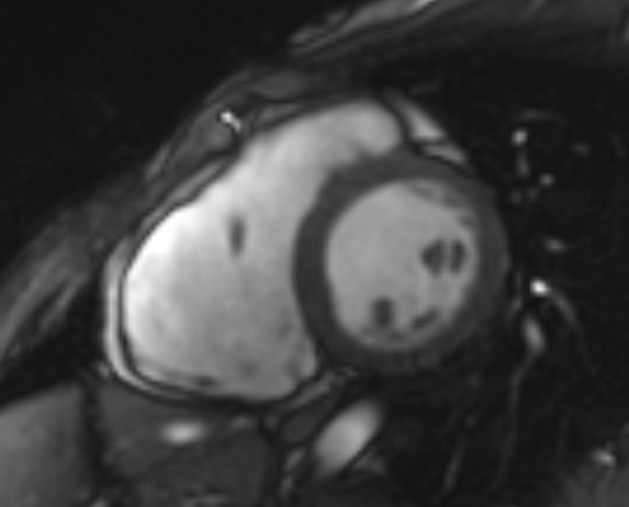 Arrhythmogenic right ventricular cardiomyopathy (Radiopaedia 69564-79464 short axis cine 161).jpg