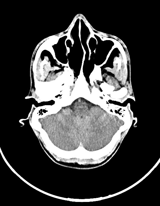Arrow injury to the brain (Radiopaedia 72101-82607 Axial non-contrast 55).jpg
