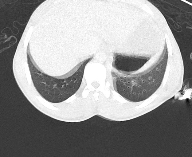 File:Arrow injury to the chest (Radiopaedia 75223-86321 Axial lung window 86).jpg