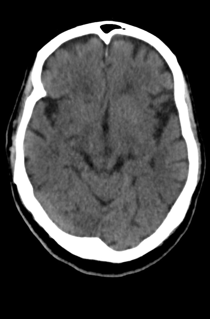 Artery of Percheron infarction (Radiopaedia 80613-94202 Axial non-contrast 82).jpg