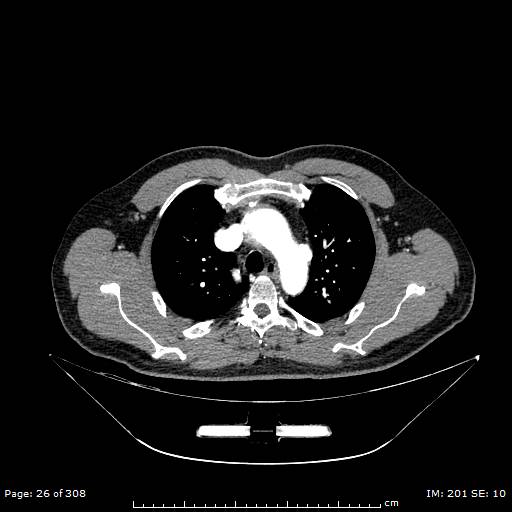 Ascending aortic aneurysm (Radiopaedia 50086-55404 A 7).jpg