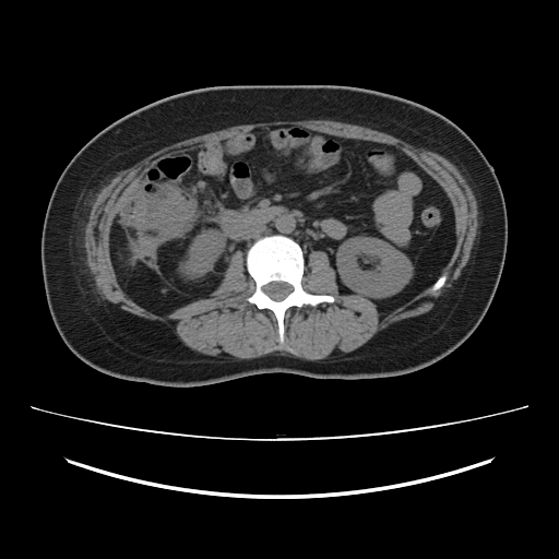 Ascending retrocecal appendicitis with liver abscesses (Radiopaedia 60066-67615 Axial non-contrast 42).jpg
